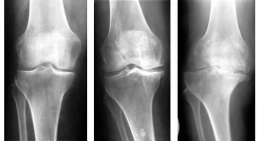 Ένα υποχρεωτικό διαγνωστικό μέτρο κατά τον εντοπισμό της αρθροπάθειας του γόνατος είναι η ακτινογραφία