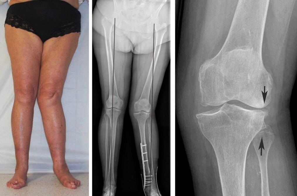 Η προχωρημένη αρθροπάθεια των αρθρώσεων του γόνατος είναι καθαρά ορατή οπτικά ακόμη και χωρίς ακτινογραφίες
