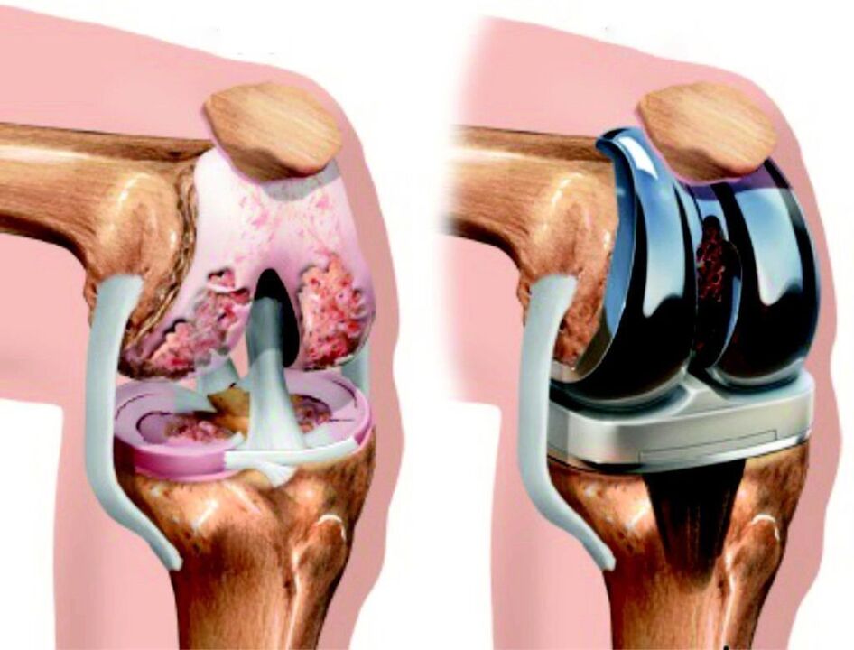 Σε περίπτωση ολικής βλάβης της άρθρωσης του γόνατος από αρθροπάθεια, μπορεί να αποκατασταθεί με ενδοπροσθετική